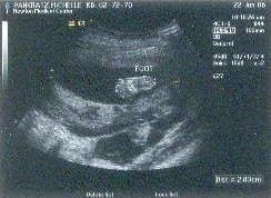 Leo Benjamin Pankratz's foot